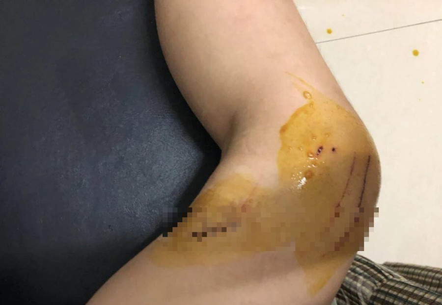 宜宾车站外一12岁女孩大腿被划伤,缝了6针!原因竟是