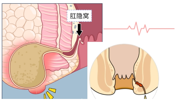 屁股上长个东西，到底是个什么，能不能挤？