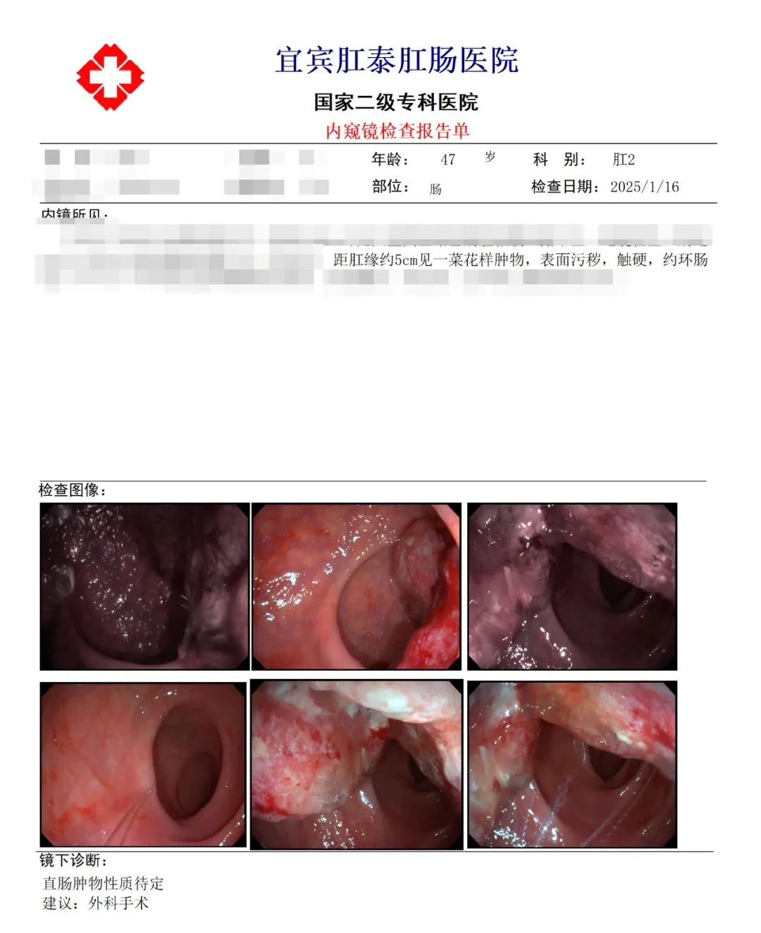 2例直肠癌：一个早期，一个晚期！这项检查年前做一次更放心